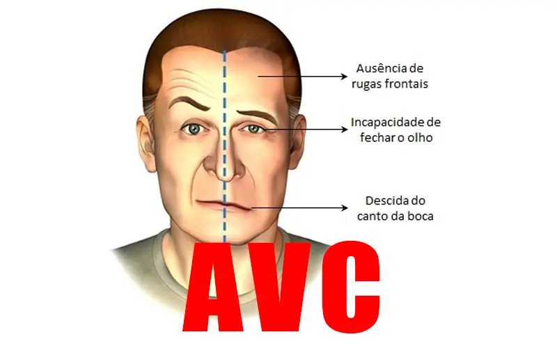 Anvisa aprova novo medicamento para prevenção do AVC
