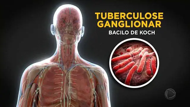 Tuberculose Ganglionar: principais informações sobre a doença