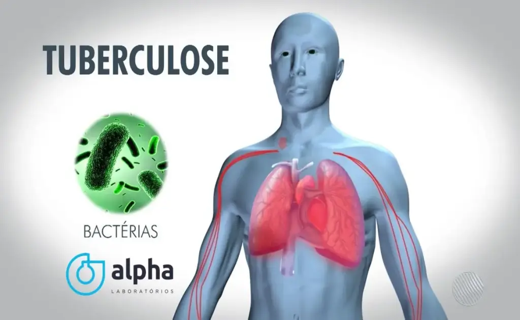 TUBERCULOSE