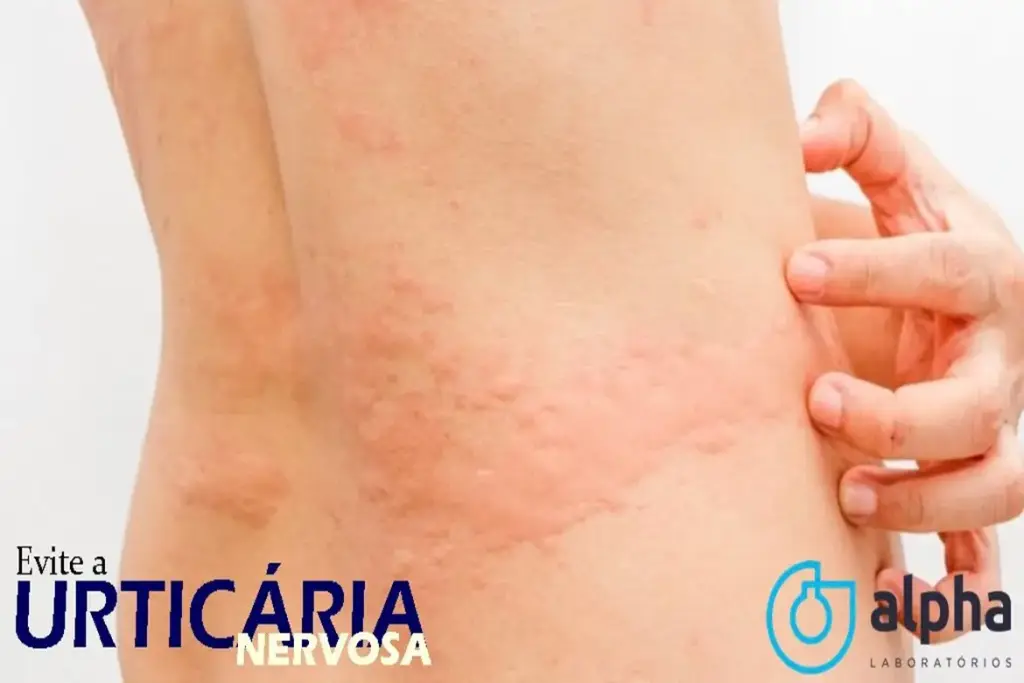 URTICÁRIA NERVOSA
